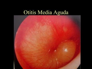 Otitis Media Aguda 