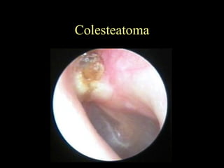 Colesteatoma 