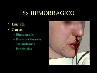 Sx HEMORRAGICO Epistaxis Causas Rinosinusales Procesos Generales Traumatismos Por cirugias 