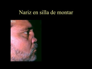 Nariz en silla de montar 