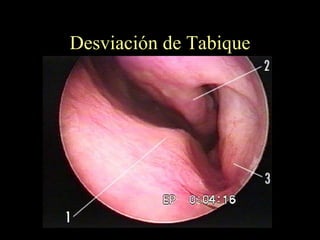 Desviación de Tabique 