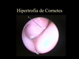 Hipertrofia de Cornetes 