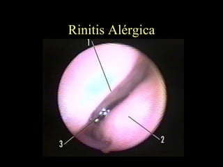 Rinitis Alérgica 