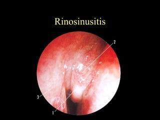Rinosinusitis 