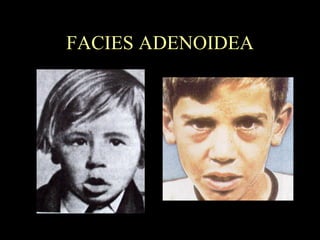 FACIES ADENOIDEA 