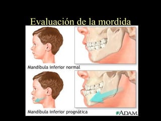 Evaluación de la mordida 