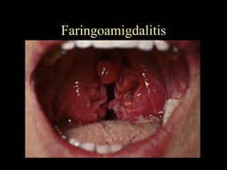 Faringoamigdalitis 