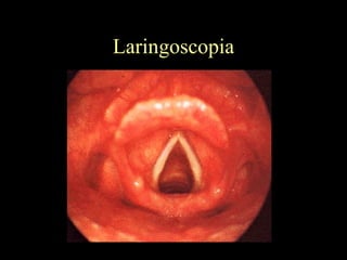 Laringoscopia 