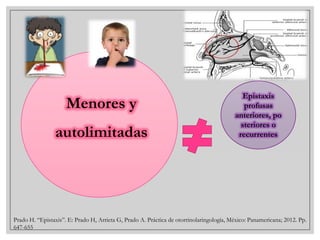 Menores y

autolimitadas

Epistaxis
profusas
anteriores, po
steriores o
recurrentes

Prado H. “Epistaxis”. E: Prado H, Arrieta G, Prado A. Práctica de otorrinolaringología, México: Panamericana; 2012. Pp.
647-655

 