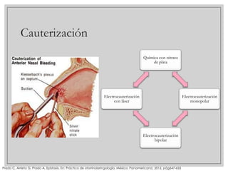 Cauterización
Química con nitrato
de plata

Electrocauterización
con láser

Electrocauterización
monopolar

Electrocauterización
bipolar

Prado C, Arrieta G, Prado A, Epistaxis. En: Práctica de otorrinolaringología, México: Panamericana; 2012, pág647-655

 