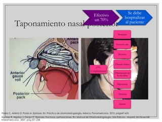 Efectivo
un 70%

Taponamiento nasal posterior

Se debe
hospitalizar
al paciente

Sinequias

Necrosis alar

Sinusitis

Choque tóxico
17%
Complicaciones

Obstrucción de
la vía aérea
Hipoxemia

Arritmia

muerte

Prado C, Arrieta G, Prado A, Epistaxis. En: Práctica de otorrinolaringología, México: Panamericana; 2012, pág647-655
Ramirez R, Algaba J, Cenjor C. Epistaxis, fracturas, perforaciones. En: Manual de Otorrinolaringología, 2da Edición., Madrid: McGraw-Hill
Interamericana, 2007. pág 221-228

 
