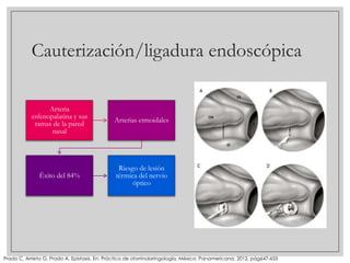 Cauterización/ligadura endoscópica
Arteria
esfenopalatina y sus
ramas de la pared
nasal

Arterias etmoidales

Éxito del 84%

Riesgo de lesión
térmica del nervio
óptico

Prado C, Arrieta G, Prado A, Epistaxis. En: Práctica de otorrinolaringología, México: Panamericana; 2012, pág647-655

 