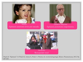 Niños
Epistaxis anteriores leves por rascado.

Adultos mayores
Epistaxis posteriores importantes.

Invierno
Resequedad nasal
Prado H. “Epistaxis”. E: Prado H, Arrieta G, Prado A. Práctica de otorrinolaringología, México: Panamericana; 2012. Pp.
647-655

 