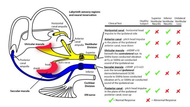 Vestibular neuritis