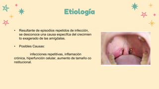 Etiología
• Resultante de episodios repetidos de infección,
se desconoce una causa específca del crecimien
to exagerado de las amígdalas.
• Posibles Causas:
infecciones repetitivas, inflamación
crónica, hiperfunción celular, aumento de tamaño co
nstitucional.
 