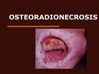 OSTEORADIONECROSIS
 