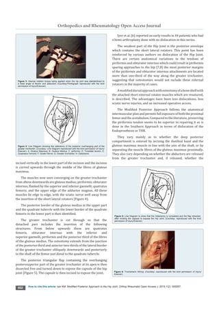 Orthopedics and Rheumatology Open Access Journal
How to cite this article: lyer KM. Modified Posterior Approach to the Hip Joint. Orthop Rheumatol Open Access J. 2015;1(2): 555557.
002
incised vertically in the lower part of the incision and the incision
is curved upwards through the middle of the fibres of gluteus
maximus.
The muscles now seen converging on the greater trochanter
from above downwards are gluteus medius; piriformis; obturator
internus, flanked by the superior and inferior gaemelli; quatratus
femoris, and the upper edge of the adductor magnus. All these
muscles lie edge to edge, with the sciatic nerve well away from
the insertion of the short lateral rotators (Figure 4).
The posterior border of the gluteus medius in the upper part
and the quadrate tubercle with the lower border of the quadrate
femoris in the lower part is then identified.
The greater trochanter is cut through so that the
detached part includes the insertion of the following
structures. From below upwards these are quatratus
femoris, obturator internus with the inferior and
superior gaemelli, piriformis and the posterior third of the fibres
of the gluteus medius. The osteotomy extends from the junction
of the posterior third and anterior two-thirds of the lateral border
of the greater trochanter obliquely downwards and posteriorly
to the shaft of the femur just distal to the quadrate tubercle.
The posterior triangular flap containing the overhanging
posterosuperior part of the greater trochanter at its apex is then
dissected free and turned down to expose the capsule of the hip
joint (Figure 5). The capsule is then incised to expose the joint.
Iyer et al. [6] reported on early results in 44 patients who had
a hemi-arthroplasty done with no dislocation in this series.
The weakest part of the Hip Joint is the posterior envelope
which contains the short lateral rotators. This point has been
reinforced by various authors on dislocation of the Hip Joint.
There are certain anatomical variations in the tendons of
piriformis and obturator internus which could result in piriformis
sparing approaches to the hip [7,8] the most posterior margins
of the piriformis and obturator internus attachments are located
more than one-third of the way along the greater trochanter,
suggesting that osteotomies would not include these external
rotators in the majority of cases.
Amodifieddorsalapproachwithosteotomyofaboneshellwith
the attached short external rotator muscles which are resutured,
is described. The advantages have been less dislocations, less
sciatic nerve injuries, and an increased operative access.
The Modified Posterior Approach follows the anatomical
intermuscularplanandpermitsfullexposureofboththeproximal
femur and the acetabulum. Compared to the literature, preserving
the piriformis tendon seems to be superior to repairing it as is
done in the Southern Approach in terms of dislocation of the
Endoprosthesis or THR.
They vary mainly as to whether the deep posterior
compartment is entered by incising the iliotibial band and the
gluteus maximus muscle in line with the axis of the shaft, or by
separating the muscle fibres of the gluteus maximus proximally.
They also vary depending on whether the abductors are released
from the greater trochanter and, if released, whether the
Figure 3: Internal rotation torque being applied when the hip joint was standardized to
a fixed angle of flexion and adduction (Courtesy:Photograph reproduced with the kind
permission of Injury/Elsevier).
Figure 4: Line Diagram showing the osteotomy of the posterior overhanging part of the
greater trochanter: (Courtesy: Line Diagram reproduced with the kind permission of Injury/
Elsevier): A: Gluteus Maximus; B: Gluteus Medius; C: piriformis; D: Triradiate tendon; E:
Quadratus Femoris; F: Sciatic Nerve; G: Greater trochanter; H: Osteotome.
Figure 5: Line Diagram to show that the Osteotomy is completed and the flap retracted,
after incising the capsule to expose the Hip Joint, (Courtesy: reproduced with the kind
permission of Injury/Elsevier).
Figure 6: Trochanteric Wiring: (Courtesy: reproduced with the kind permission of Injury/
Elsevier).
 