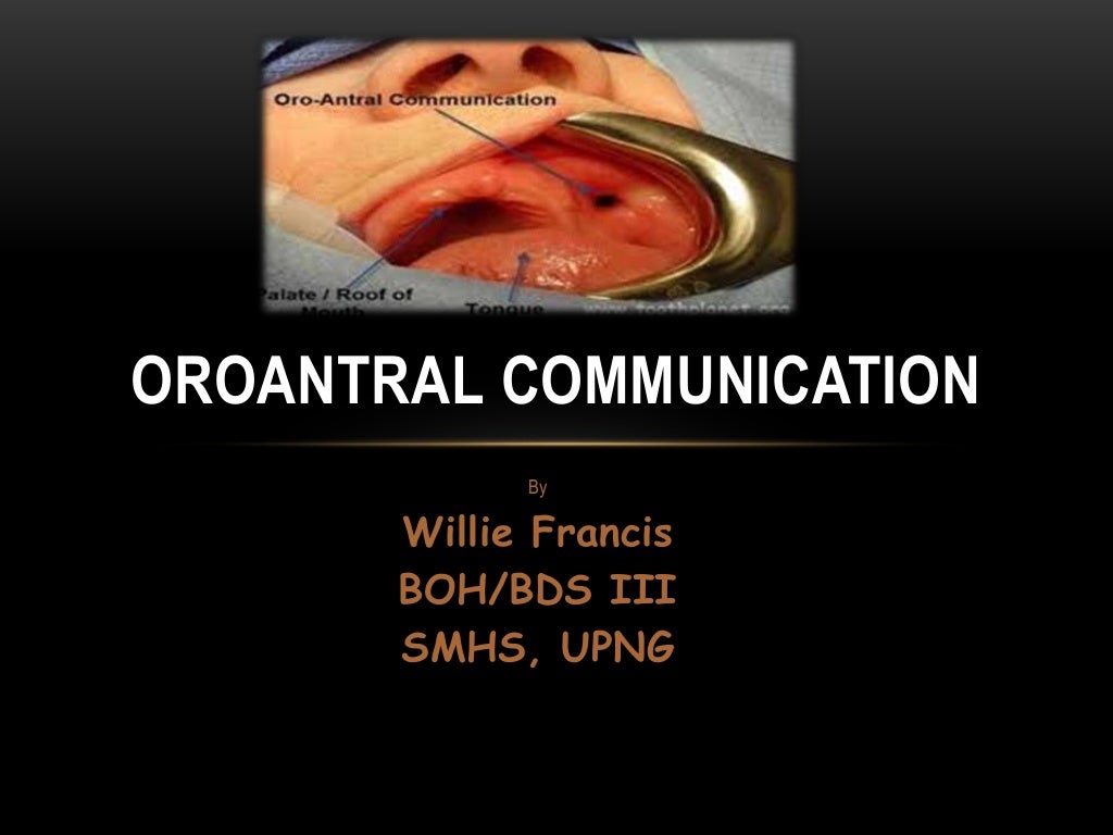 Oroantral communication