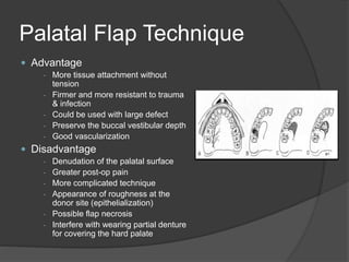 Palatal Flap Technique
 Advantage
- More tissue attachment without
tension
- Firmer and more resistant to trauma
& infection
- Could be used with large defect
- Preserve the buccal vestibular depth
- Good vascularization
 Disadvantage
- Denudation of the palatal surface
- Greater post-op pain
- More complicated technique
- Appearance of roughness at the
donor site (epithelialization)
- Possible flap necrosis
- Interfere with wearing partial denture
for covering the hard palate
 