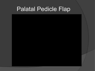 Palatal Pedicle Flap
 