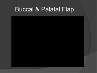 Buccal & Palatal Flap
 