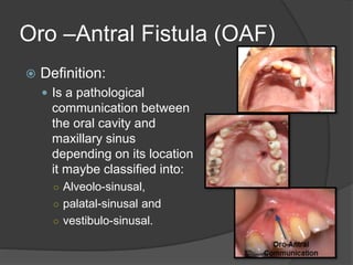 Oro –Antral Fistula (OAF)
 Definition:
 Is a pathological
communication between
the oral cavity and
maxillary sinus
depending on its location
it maybe classified into:
○ Alveolo-sinusal,
○ palatal-sinusal and
○ vestibulo-sinusal.
 