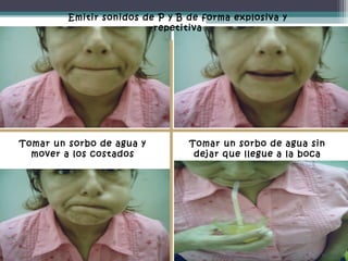 Emitir sonidos de P y B de forma explosiva y
repetitiva

Tomar un sorbo de agua y
mover a los costados

Tomar un sorbo de agua sin
dejar que llegue a la boca

 
