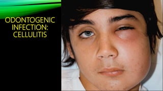 Orofacial infection part 1 | PPTX