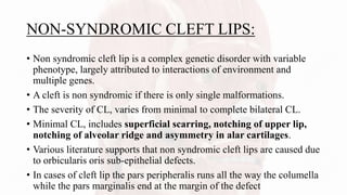 NON-SYNDROMIC CLEFT LIPS:
• Non syndromic cleft lip is a complex genetic disorder with variable
phenotype, largely attributed to interactions of environment and
multiple genes.
• A cleft is non syndromic if there is only single malformations.
• The severity of CL, varies from minimal to complete bilateral CL.
• Minimal CL, includes superficial scarring, notching of upper lip,
notching of alveolar ridge and asymmetry in alar cartilages.
• Various literature supports that non syndromic cleft lips are caused due
to orbicularis oris sub-epithelial defects.
• In cases of cleft lip the pars peripheralis runs all the way the columella
while the pars marginalis end at the margin of the defect
 