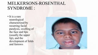 MELKERSONS-ROSENTHAL
SYNDROME :
• It is a rare
neurological
characterized by
recurring facial
paralysis, swelling of
the face and lips
(usually the upper
lip), and the
development of folds
and furrows
 