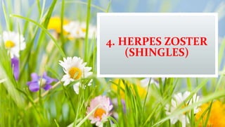 4. HERPES ZOSTER
(SHINGLES)
 