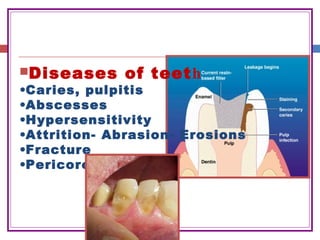 Diseases of teeth
•Caries, pulpitis
•Abscesses
•Hypersensitivity
•Attrition- Abrasion- Erosions
•Fracture
•Pericoronitis
 