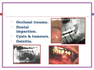  Occlusal trauma.
 Dental
impaction.
 Cysts & tumours.
 Osteitis.
 