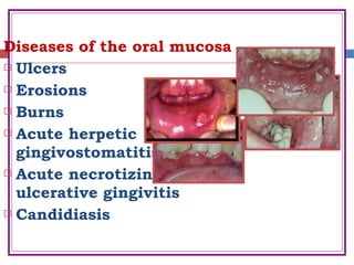 Diseases of the oral mucosa
 Ulcers
 Erosions
 Burns
 Acute herpetic
gingivostomatitis
 Acute necrotizing
ulcerative gingivitis
 Candidiasis
 