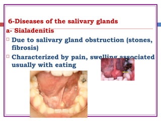 6-Diseases of the salivary glands
a- Sialadenitis
 Due to salivary gland obstruction (stones,
fibrosis)
 Characterized by pain, swelling associated
usually with eating
 