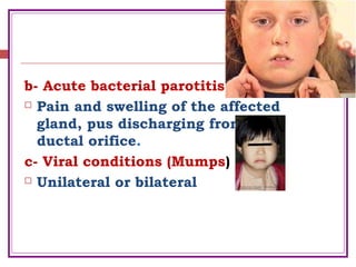 b- Acute bacterial parotitis
 Pain and swelling of the affected
gland, pus discharging from the
ductal orifice.
c- Viral conditions (Mumps)
 Unilateral or bilateral
 