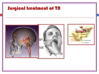 Surgical treatment of TN
 