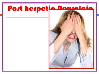 Post herpetic Neuralgia
 