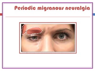 Periodic migranous neuralgia
 