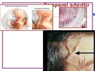 Temporal arteritis
 
