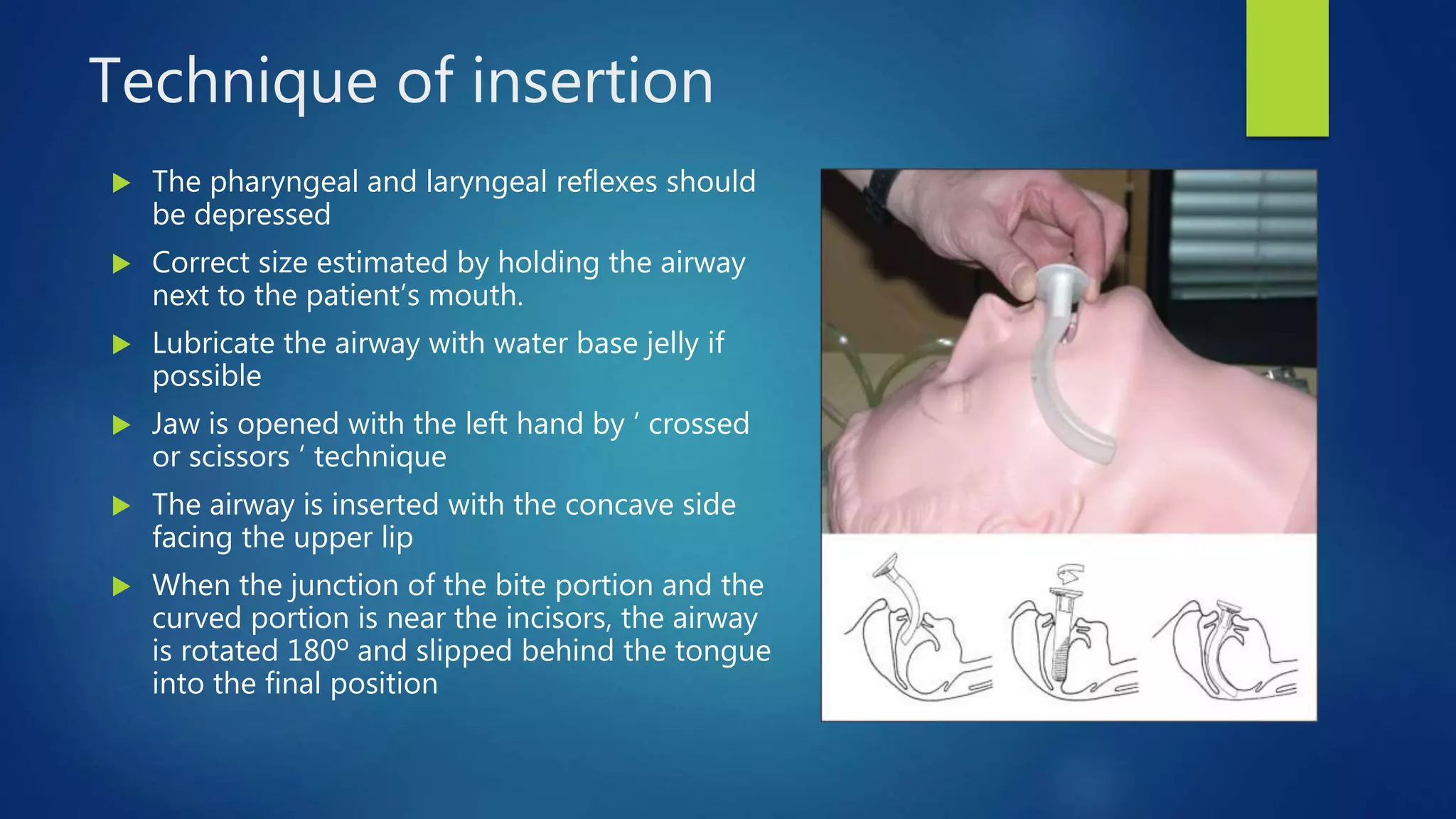 Oropharyngeal Airway And Nasopharyngeal Airway 114337 1 pptx Oropharyngeal Airway And Nasopharyngeal Airway 114337 1 pptx