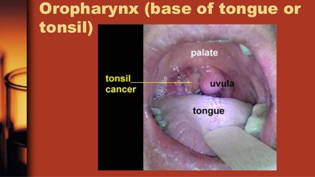 Oropharynx cancer and HPV in 2019
