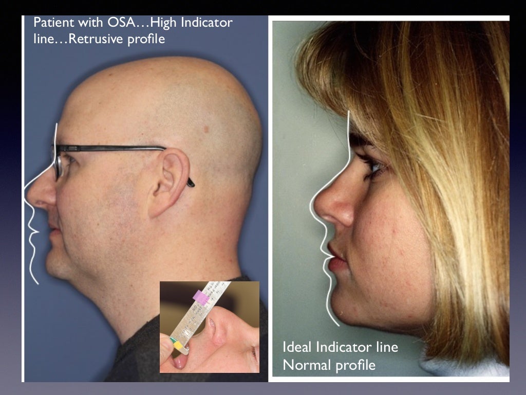 ⢠Facial Changes/ Relaxed Musculature