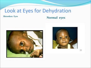 Look at Eyes for Dehydration
Shrunken Eyes
Normal eyes
 