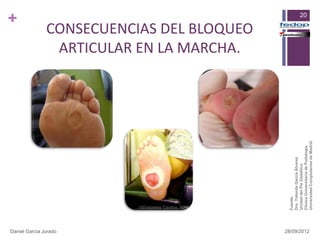 +




Daniel García Jurado
                                                             ARTICULAR EN LA MARCHA.
                                                            CONSECUENCIAS DEL BLOQUEO




                       Fuente:
                       Dra. Yolanda García Álvarez
                       Unidad del Pie Diabético
                                                                                        20




                       Clínica Universitaria de Podología
28/09/2012




                       Universidad Complutense de Madrid
 
