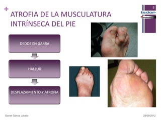 +                                      5

    ATROFIA DE LA MUSCULATURA
    INTRÍNSECA DEL PIE

            DEDOS EN GARRA




                   HALLUX




    DESPLAZAMIENTO Y ATROFIA




Daniel García Jurado            28/09/2012
 