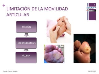 +                                           6

    LIMITACIÓN DE LA MOVILIDAD
    ARTICULAR

                       PRESIÓN




                   HIPERQUERATOSIS




                       ÚLCERA




Daniel García Jurado                 28/09/2012
 