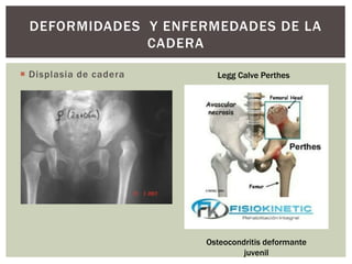  Displasia de cadera
DEFORMIDADES Y ENFERMEDADES DE LA
CADERA
Legg Calve Perthes
Osteocondritis deformante
juvenil
 