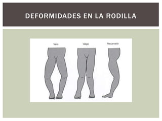 DEFORMIDADES EN LA RODILLA
 