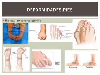  Pie equino varo congénito
DEFORMIDADES PIES
 